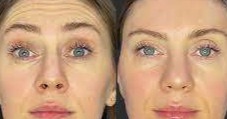 Botox Near Me Specials: Your Guide to Smooth Skin at the Best Price